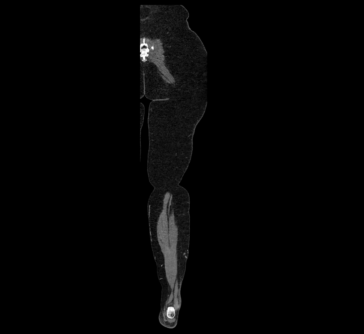 CTA lower limb coronal cross sectional anatomy labelled image _81 (2).webp